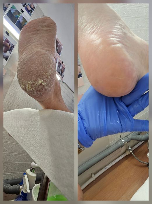 Pedichiură clasică și medicală