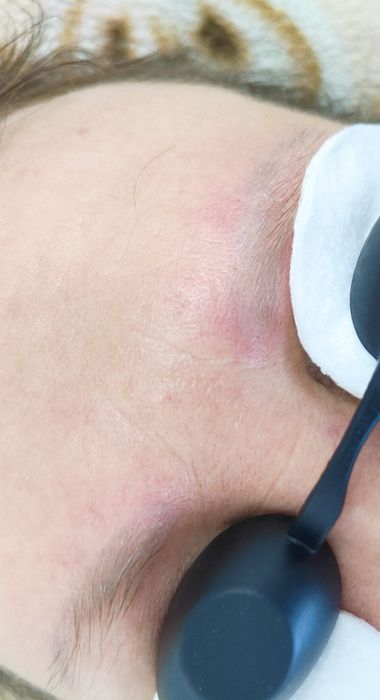 Удаление татуажа, тату