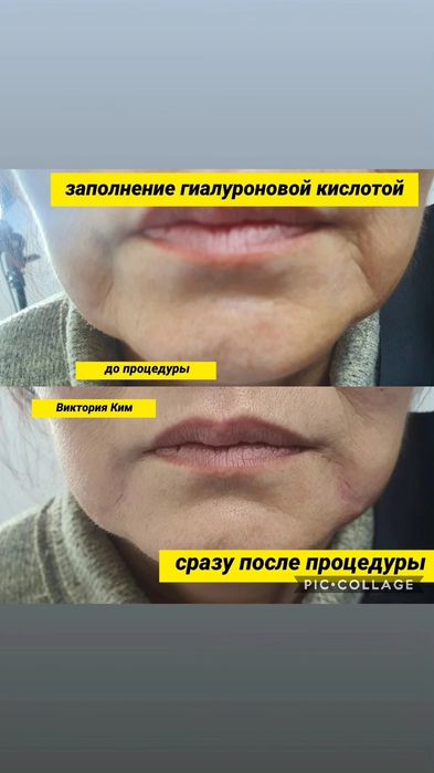 Заполнение носогубки Увеличение губ