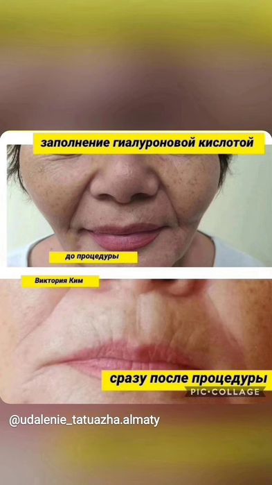 Заполнение носогубки Увеличение губ