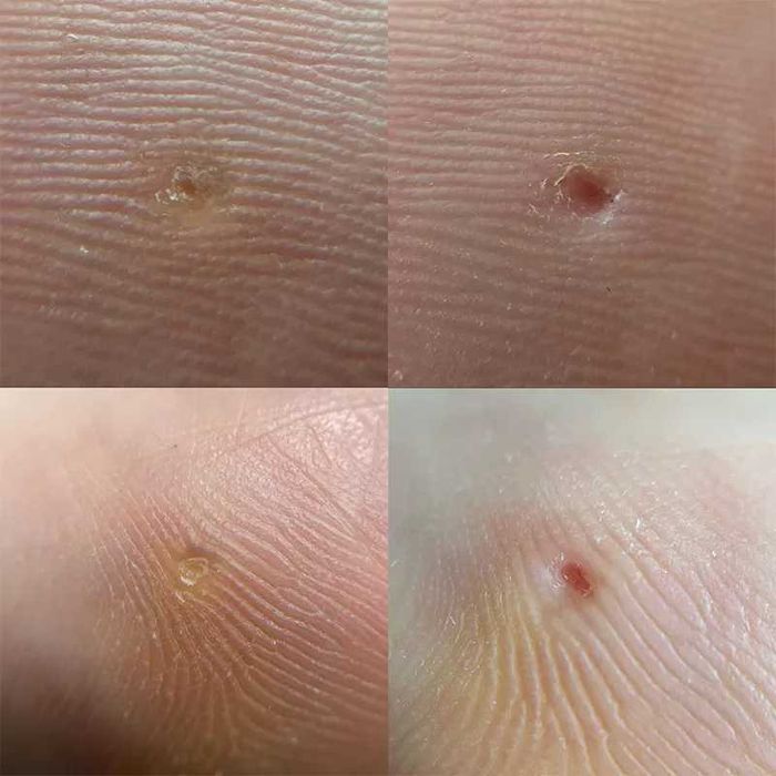 Afectiuni Unghii si Talpi - Podologie doar cu asistenti medicali