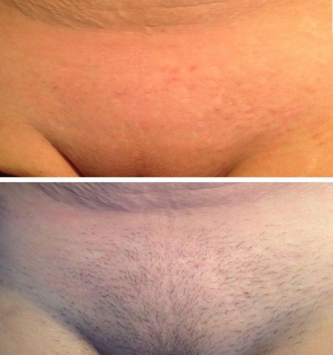 Эпиляция депиляция для мужчины и женщины