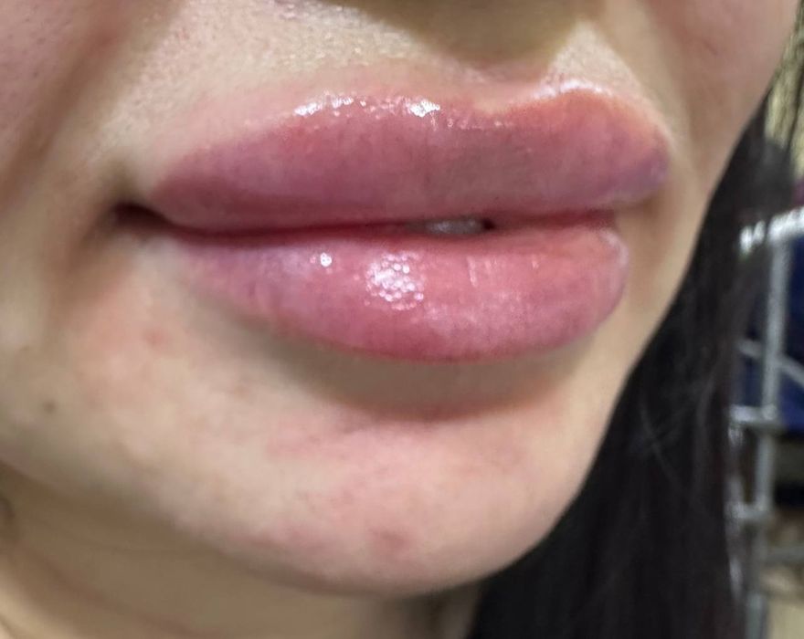 Губы, Ботокс, Филлеры