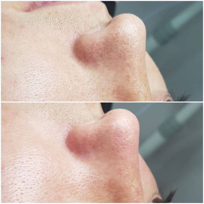 Косметолог.  Чистка лица