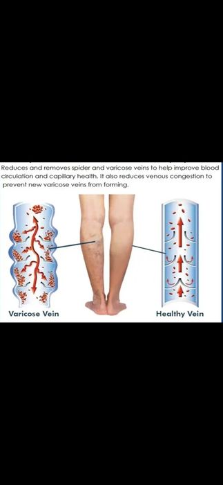 Crema varice tratament picioare