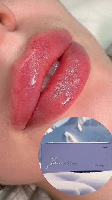 Красота это -губки бантиком на новый год! Botox full face