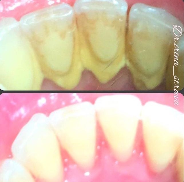 Профессиональная чистка зубов(200тсум)