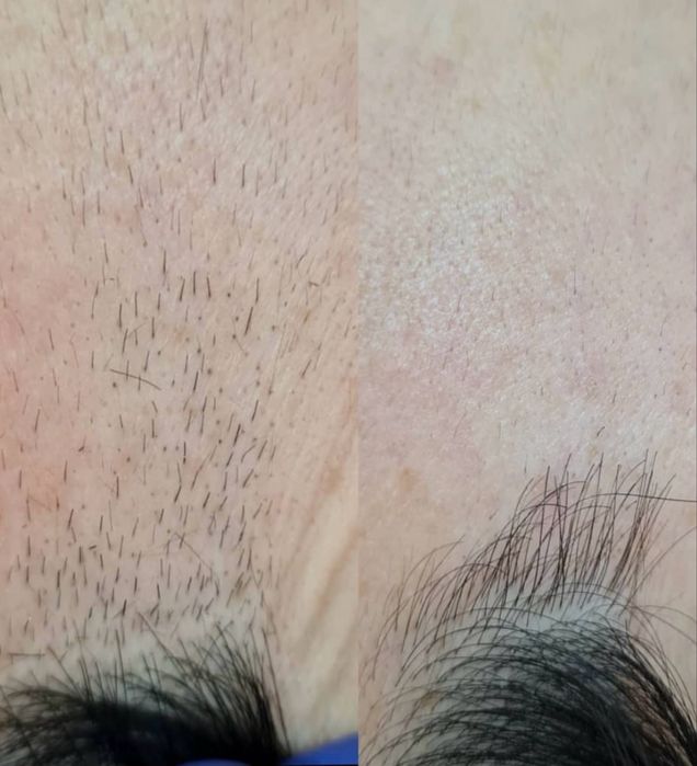 Лазерный аппарат сопрано титанум