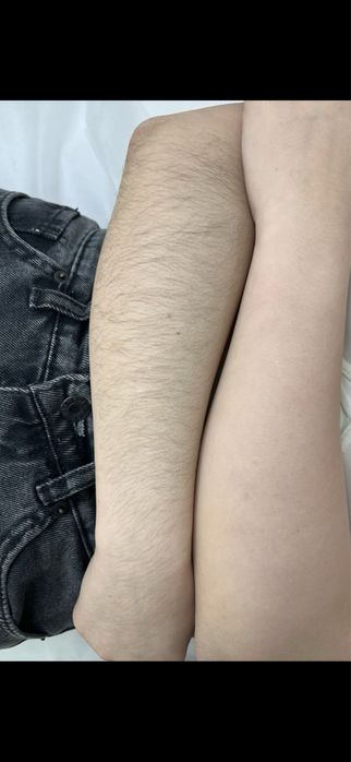 Шугаринг / воскинг