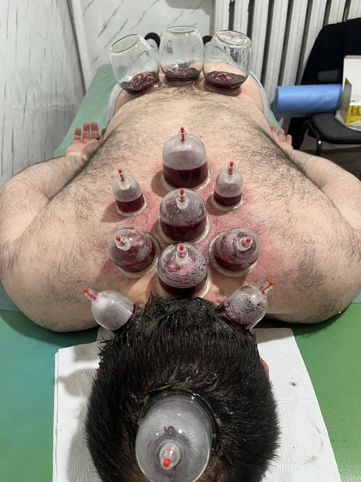 Хиджама и шертпе в городе Алматы