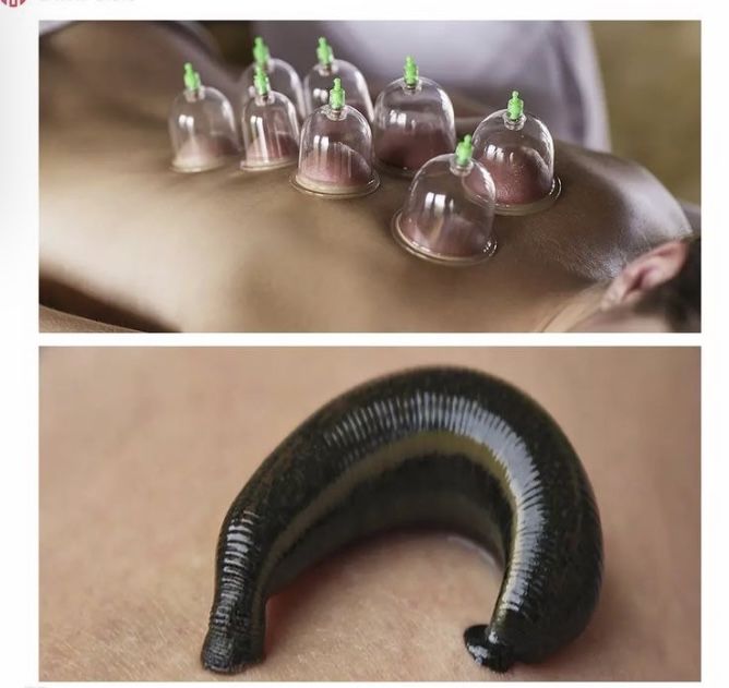 Хиджама пиявки