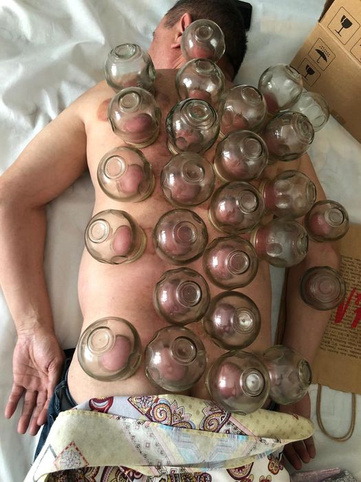 Медицинские банки с огнём.