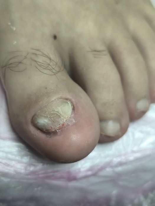 Медицински педикюр