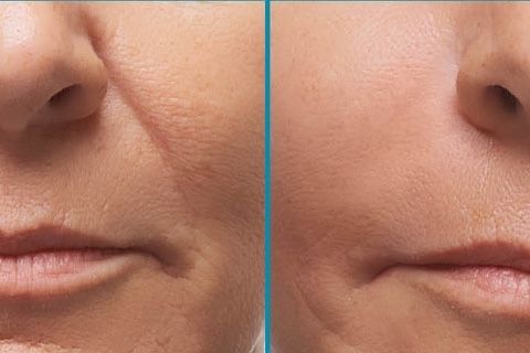 Супер акция 800тыс Носогубные складки