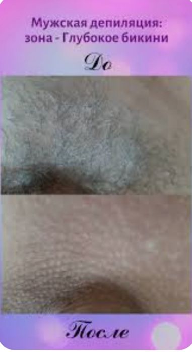 Депиляция для мужчин и женщин
