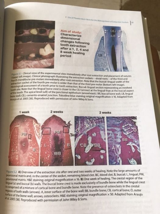 Platelet Rich Fibrin in Regenerative Dentistry 2017