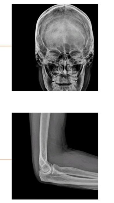 Портативный цифровой рентген аппарат. Mobile X-ray