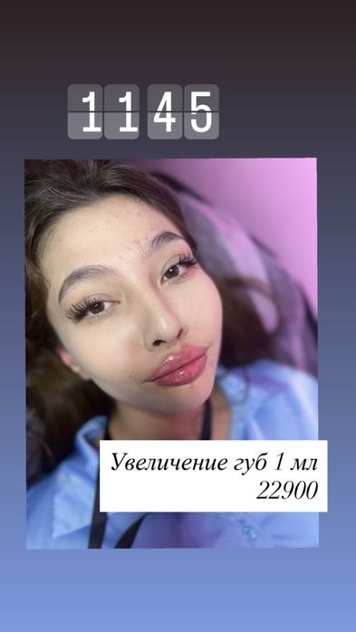 Увелечение губ . Косметолог