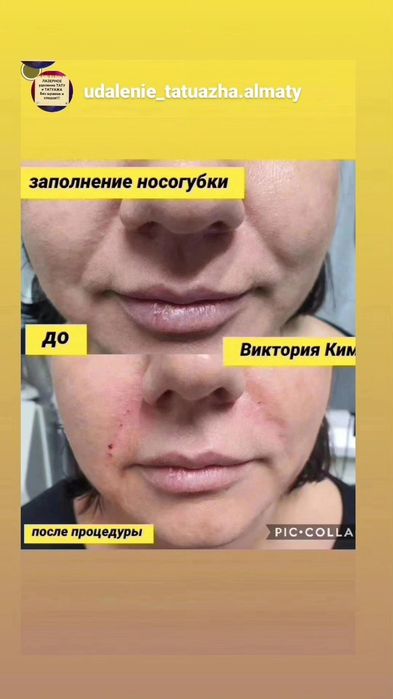 Заполнение носогубки Увеличение губ