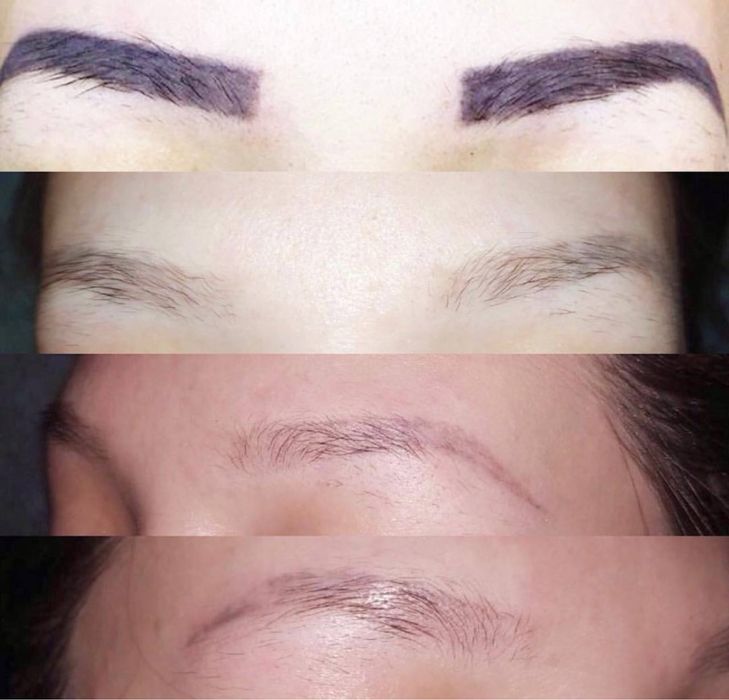 Лазер | Ботокс | Пилинги | Удаление татуажа | Косметолог