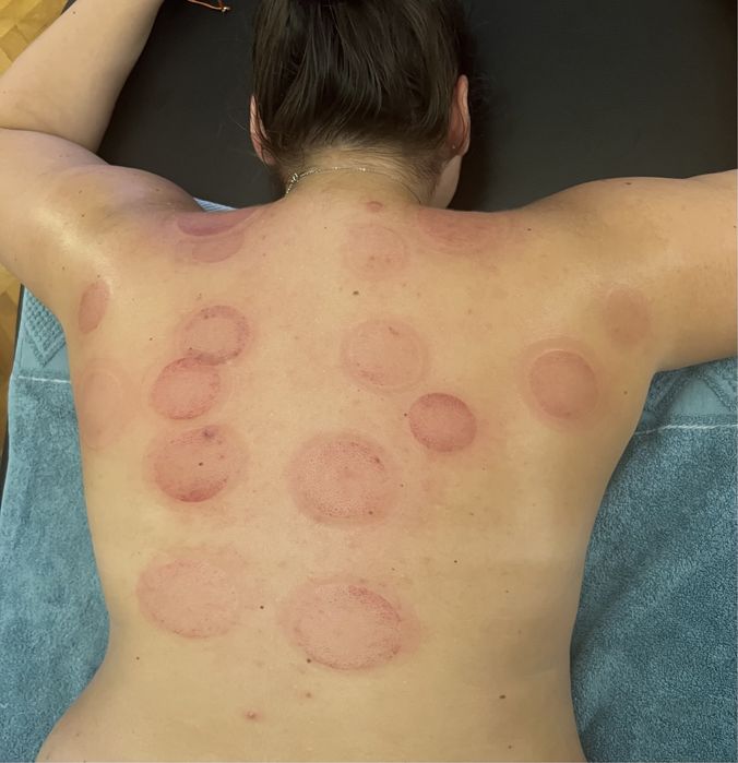 Kinetoterapie, Masaj, Chiropractică și Acupunctură (Dryneedling)