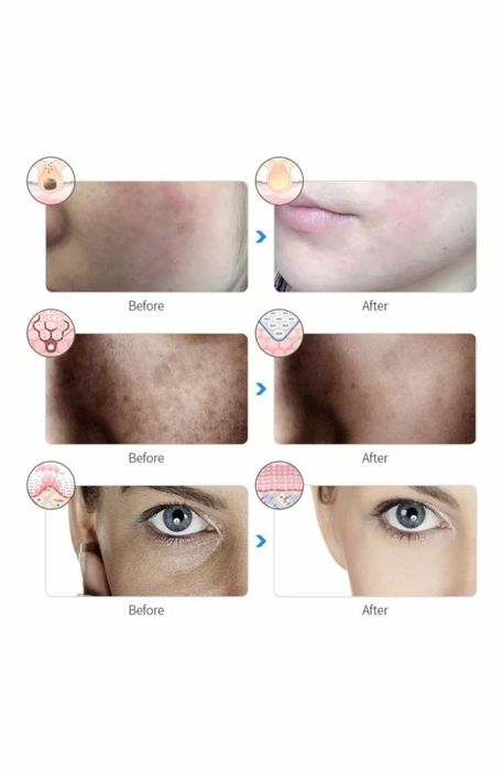 Маска светотерапия