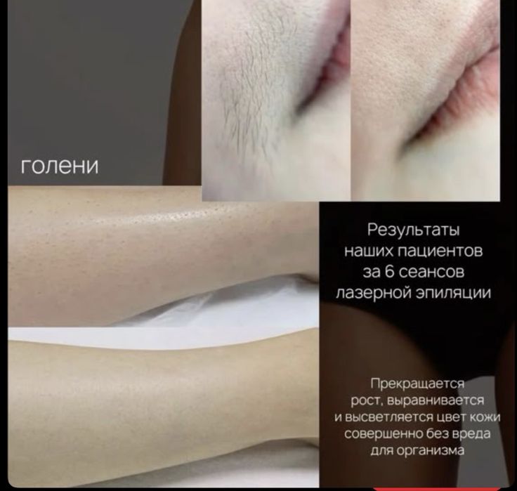 Лазерная эпиляция по выгодным ценам скидки на все зоны