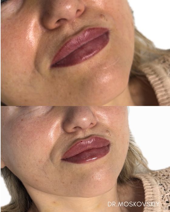 Увеличение губ|Алмата АКЦИЯ