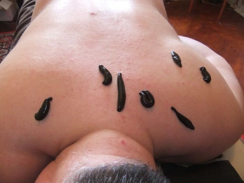 Как выглядит укус пиявки Как выглядит укус пиявки