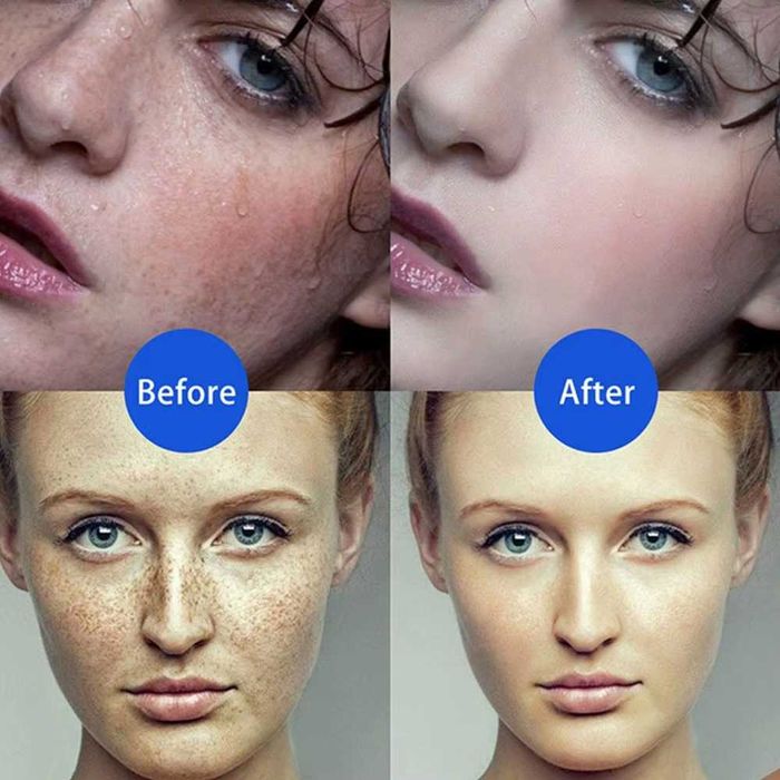 Ручка для удаления бородавок, папиллом, татуировок