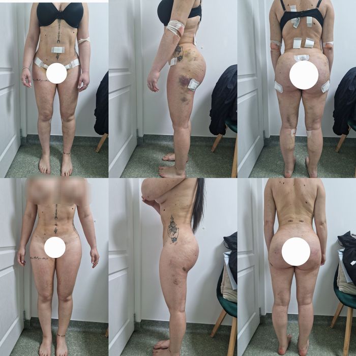 Drenaj limfatic manual post opertor bbl , liposuctie , abdominoplastie