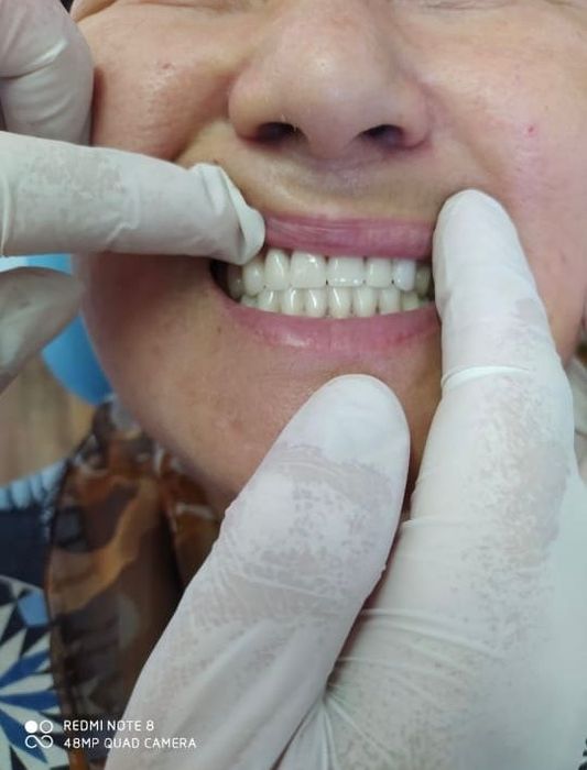 Сьемные зубные протезы быстро и качественно