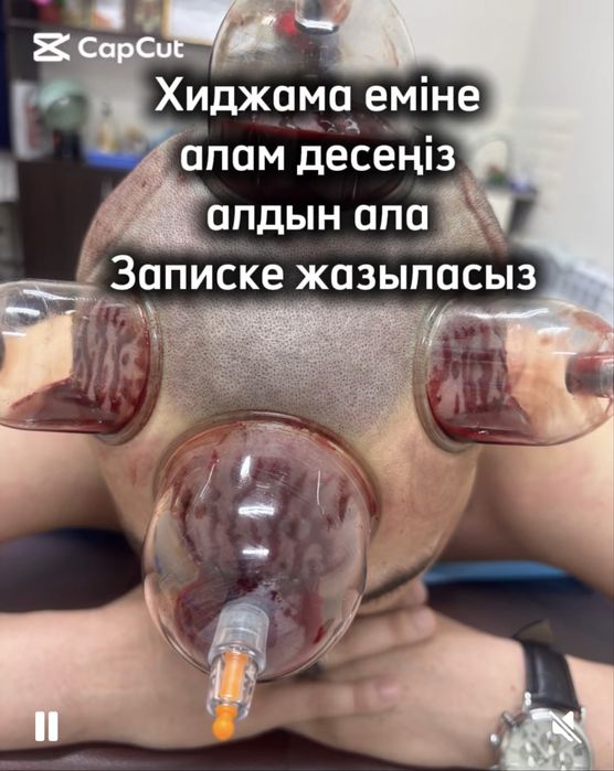 Хиджама, Пиявки Массаж емдері