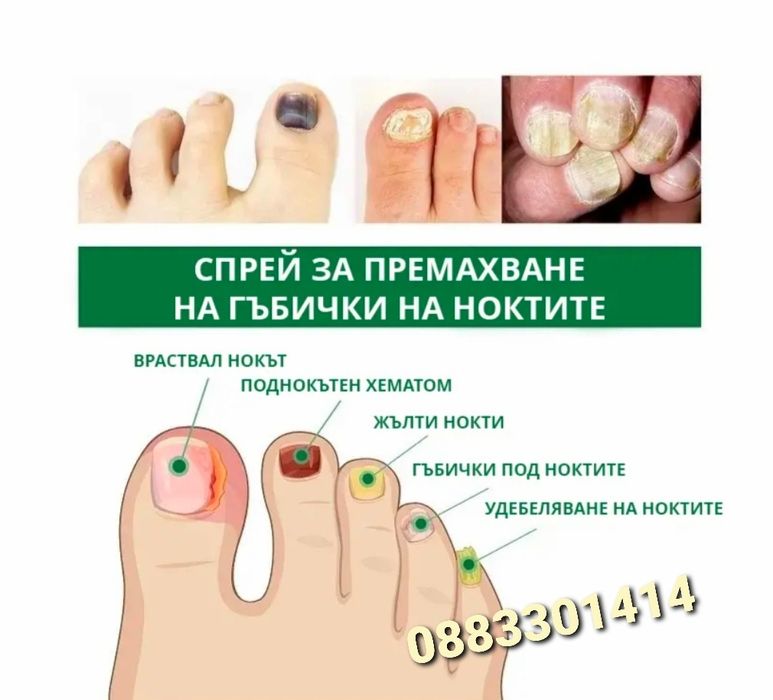 Спрей за нокти Премахва гъбички на ноктите