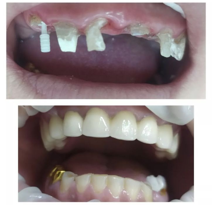 Металлокерамика . Зубные коронки.