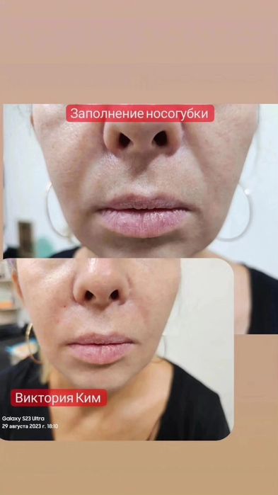 Заполнение носогубки Увеличение губ