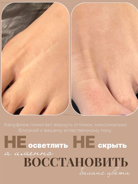 Витилиго камуфляж рубцов