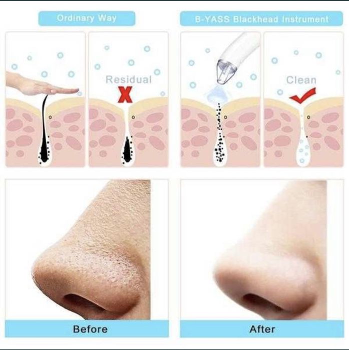 Бетти тазалаушы Вакумный очиститель черных точек.