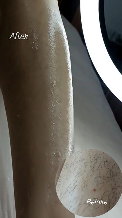 Профессиональная депиляция шугаринг, полимерный воск