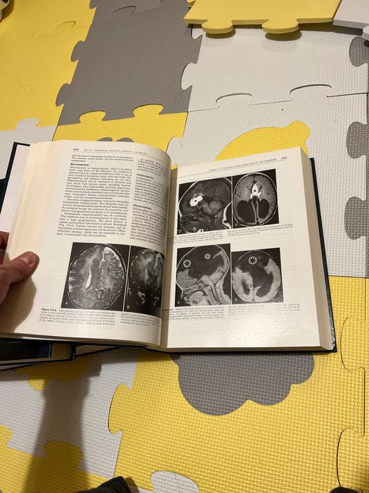 Неврохирургия на Тиндал 3 тома. Practice of Neurosurgery Tindall