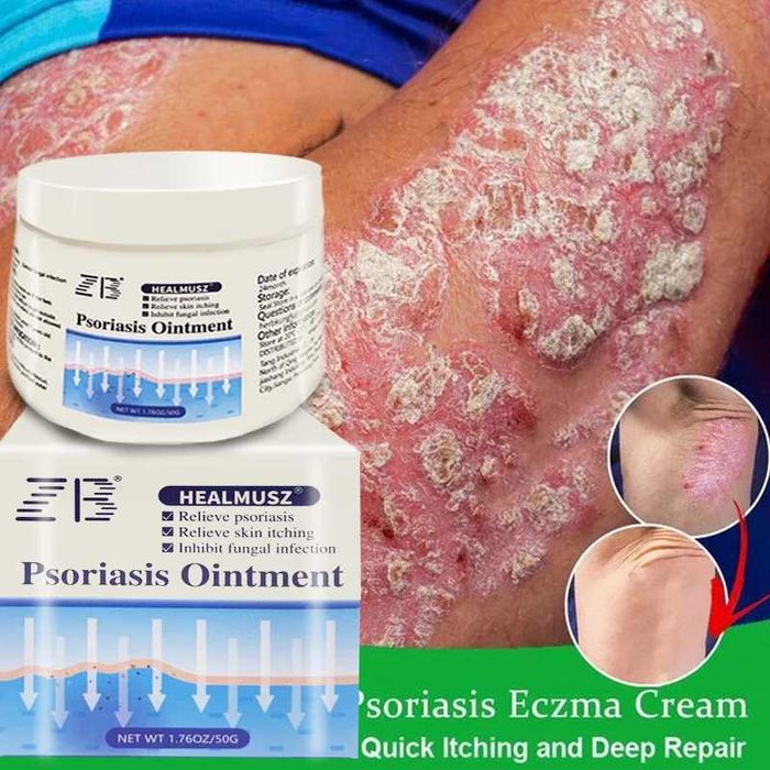 ZB Healmusz*2 bucati-Crema psoriazis, dermatita, prurit, antibacterian