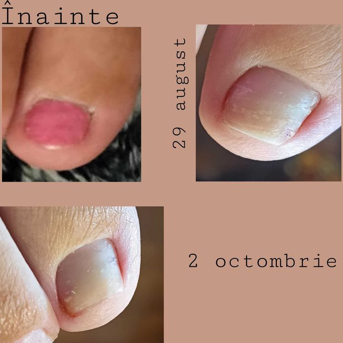 Pedichiură medicală Târgu Mureș