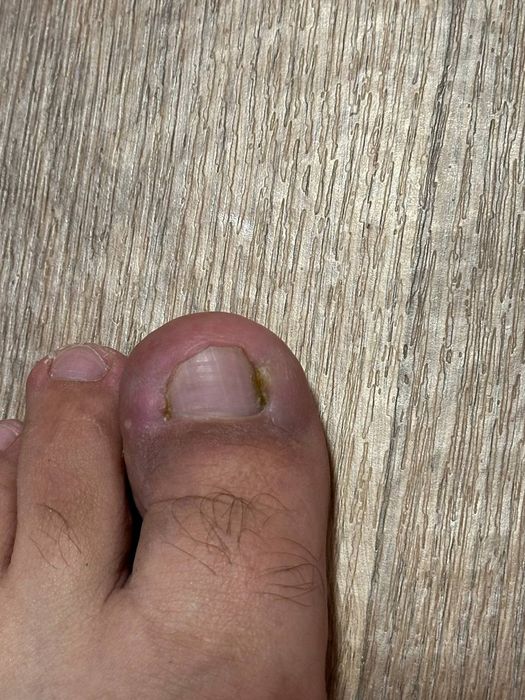 Лечение и исправление вросших ногтей.  Падолог