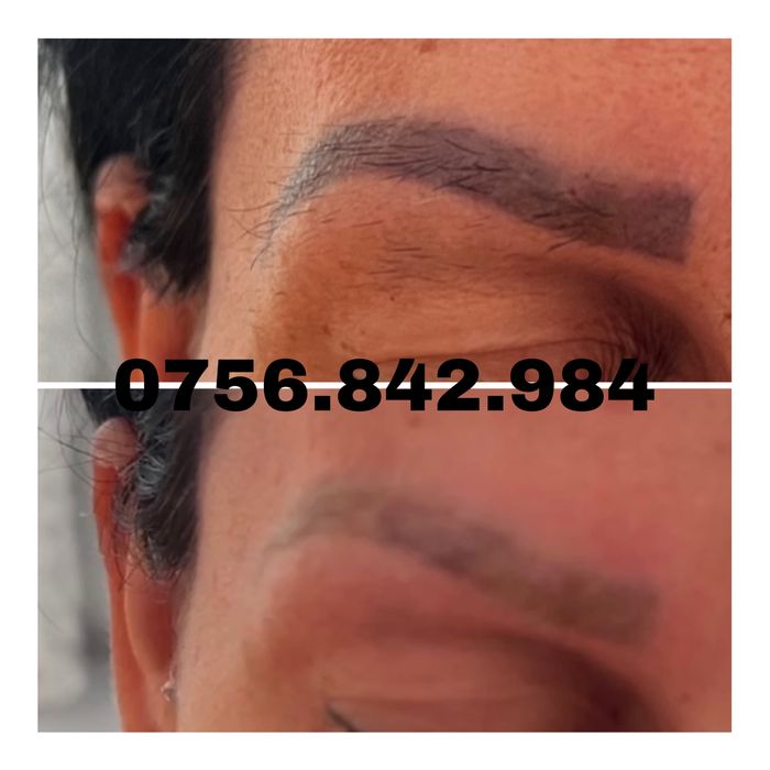 Arad-Eliminare tatuaj cu laser, preturi de la 100 ron