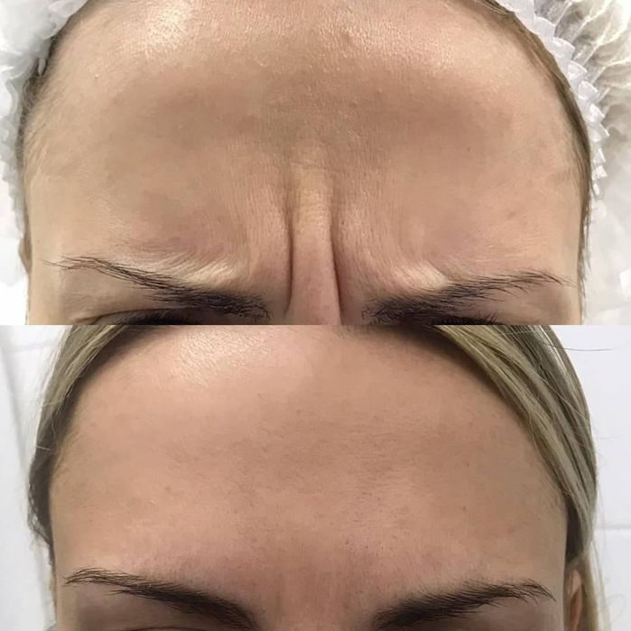 Ботокс мезаботокс фуллфейс