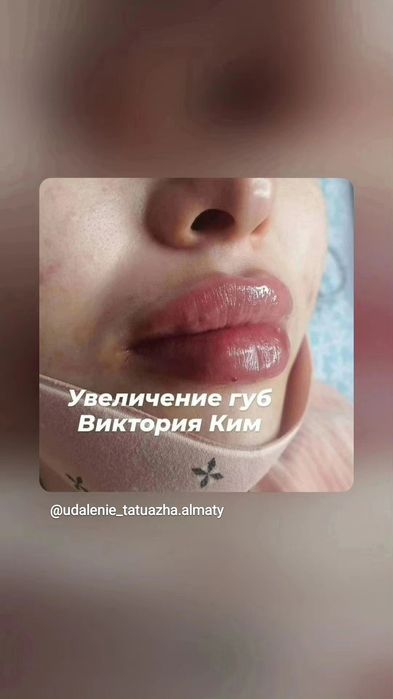 Увеличение губ заполнение носогубки