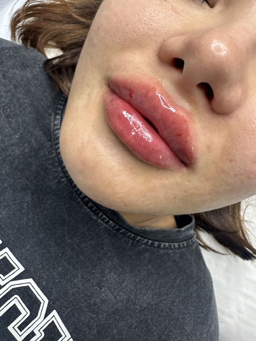 Акция Увеличение Губ