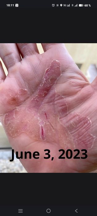 Крем Псариоза очень эффективно гарантия