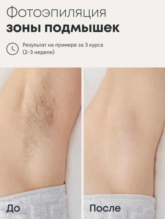 Photoepilator arzon narxda bervoraman
