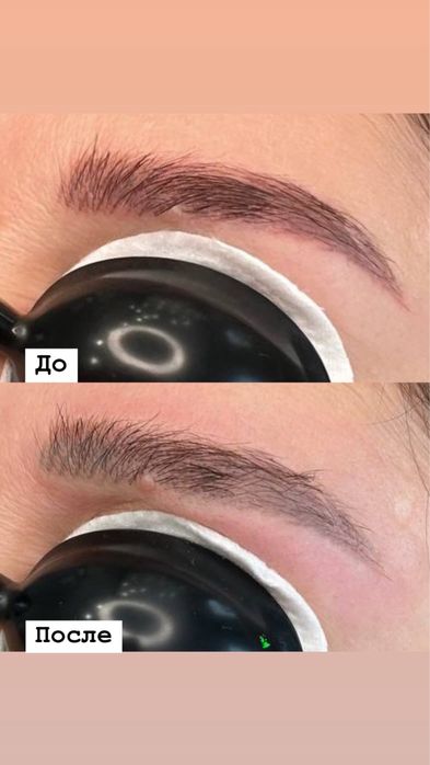 Лазерное удаление татуажа